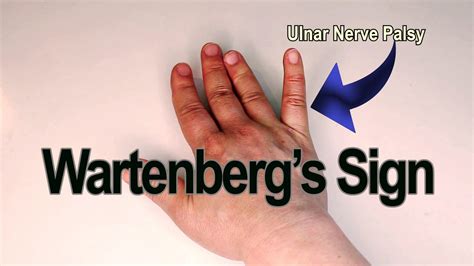 Wartenberg's Sign 